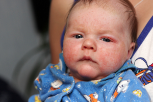 Eczema in Children Baby How to treat Eczema Naturally