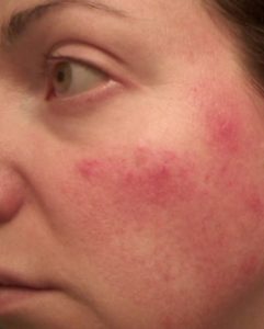Rosy JulieBC Rosacea Flare-Up 2018