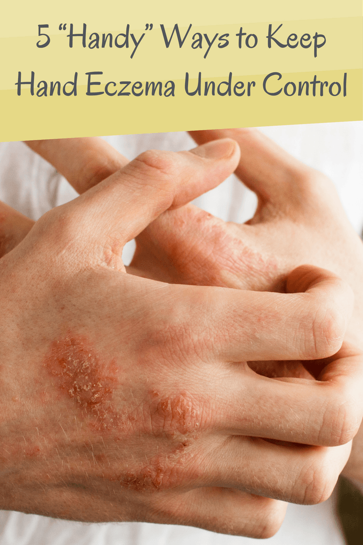 Hand Eczema - Pinterest