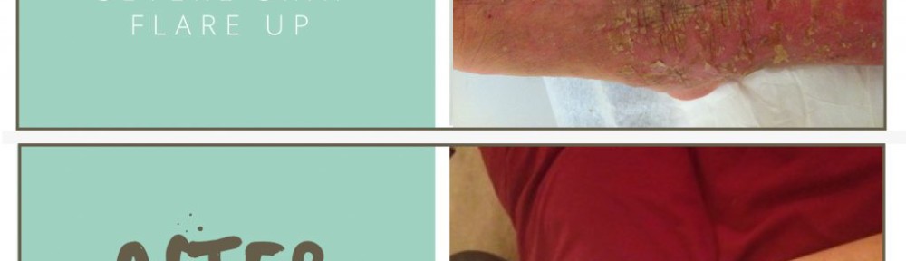 eczema-balm-before.after_