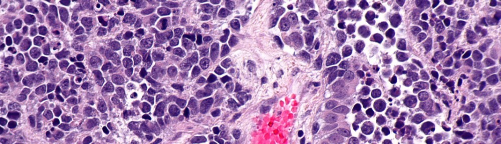 Small_cell_carcinoma_of_the_urinary_bladder_-_high_mag